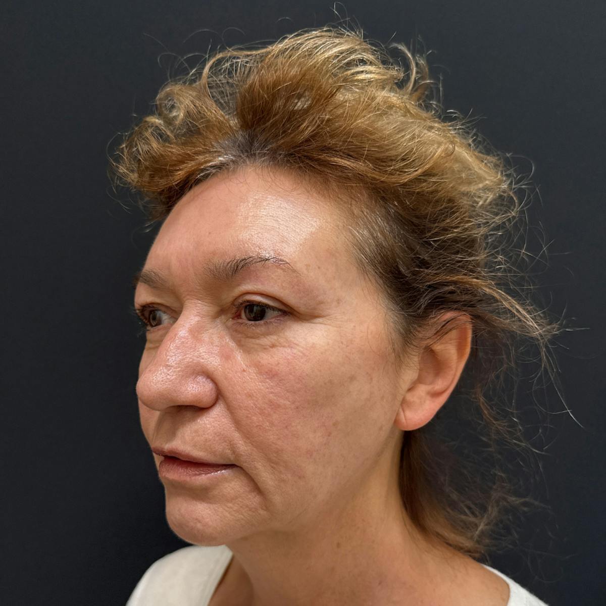 Dermal Fillers Before & After Gallery - Patient 392436 - Image 3