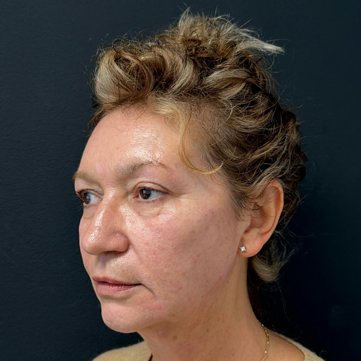 Dermal Fillers Before & After Gallery - Patient 392436 - Image 4