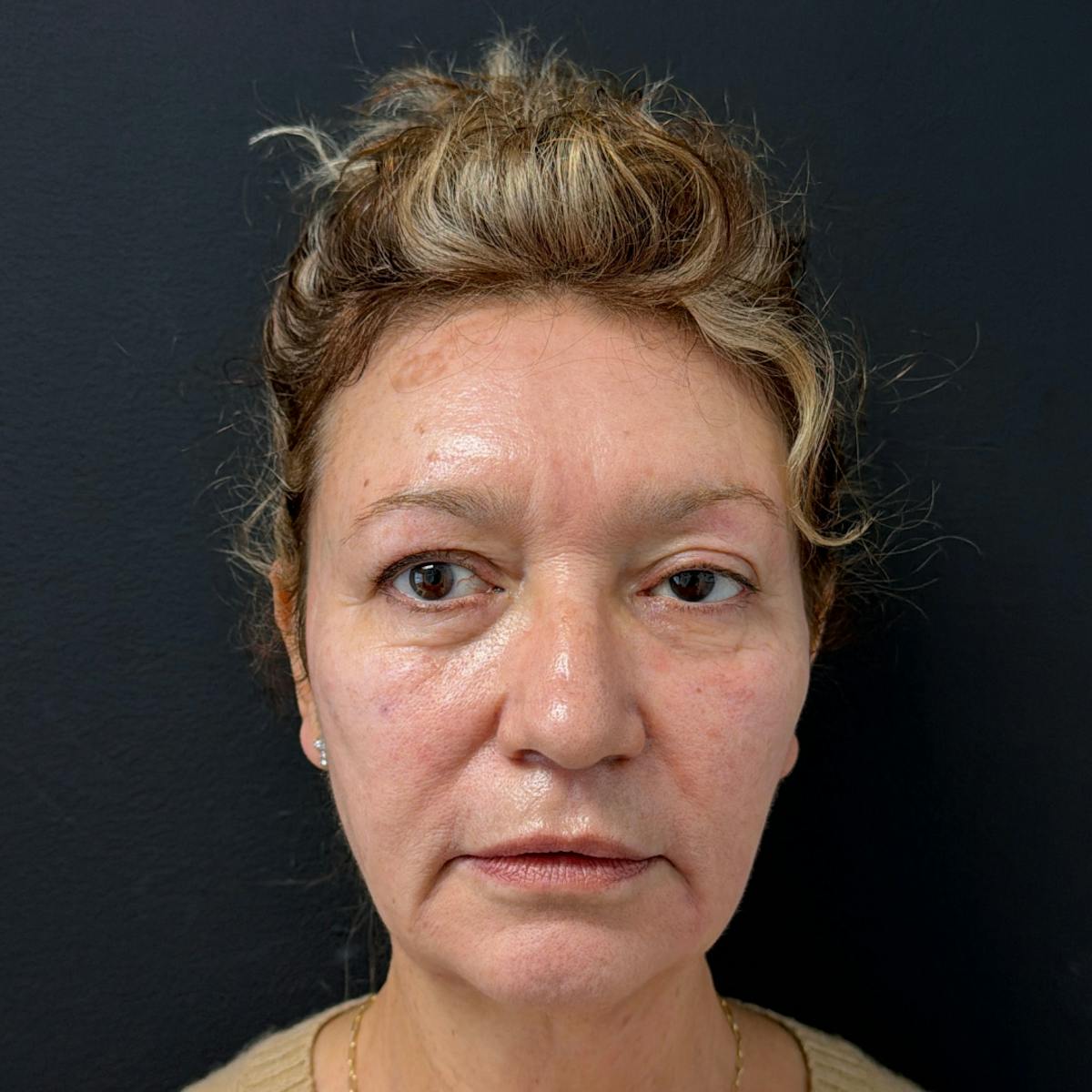 Dermal Fillers Before & After Gallery - Patient 392436 - Image 2