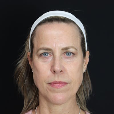 PRF Before & After Gallery - Patient 371141 - Image 1