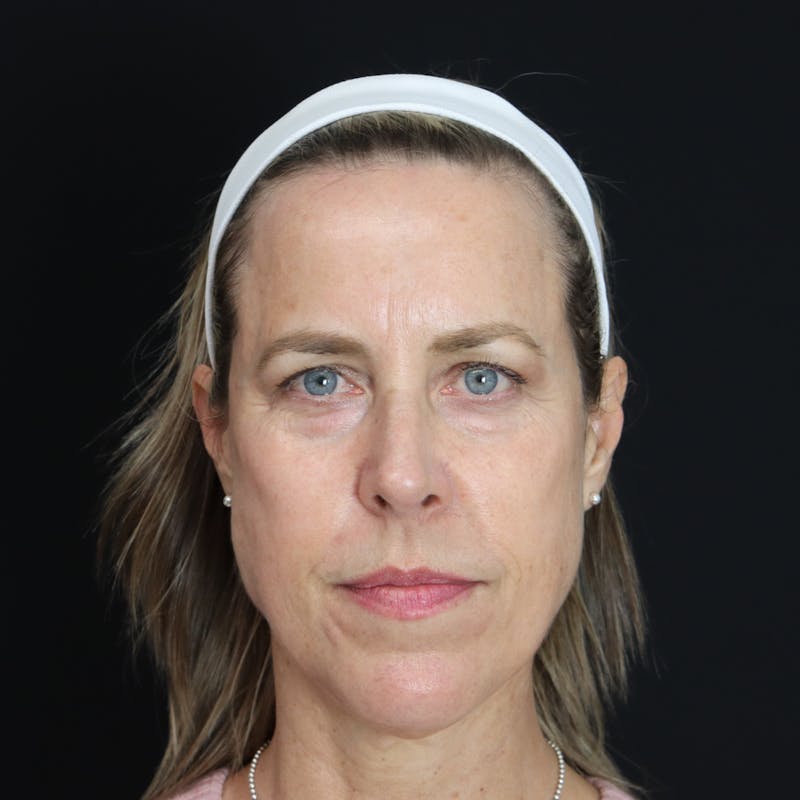 PRF Before & After Gallery - Patient 371141 - Image 1