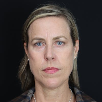 PRF Before & After Gallery - Patient 371141 - Image 2