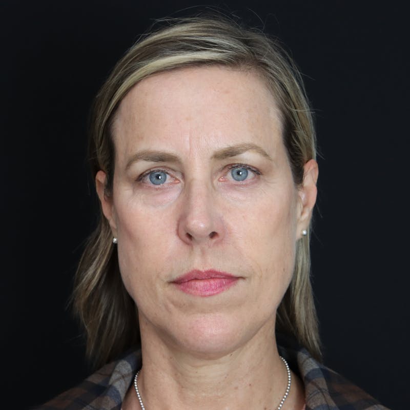 PRF Before & After Gallery - Patient 371141 - Image 2