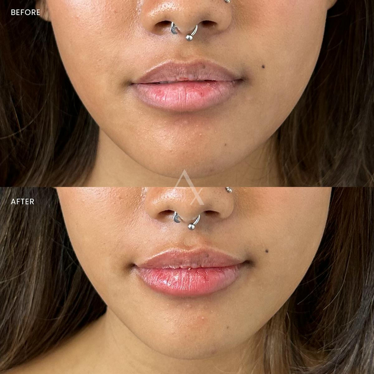 Dermal Fillers Before & After Gallery - Patient 323457 - Image 2
