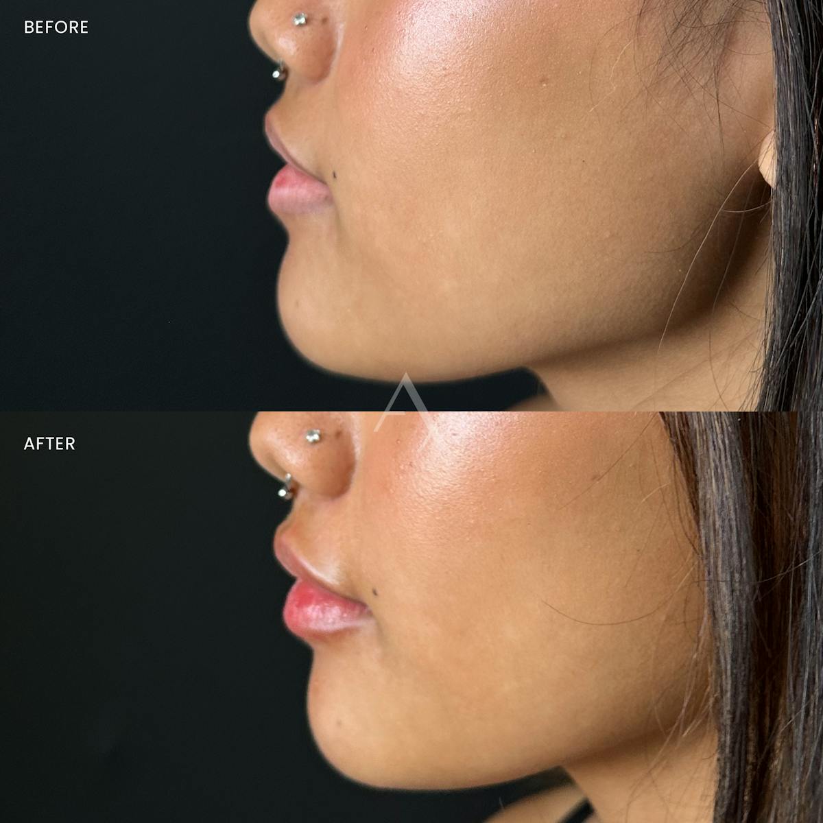 Dermal Fillers Before & After Gallery - Patient 323457 - Image 1
