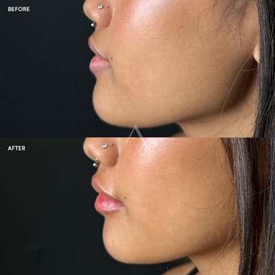 Dermal Fillers Before & After Gallery - Patient 323457 - Image 1