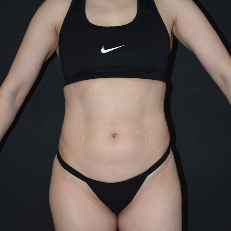 Liposuction Before & After Gallery - Patient 407711 - Image 1