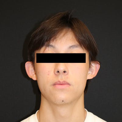 Otoplasty Before & After Gallery - Patient 749293 - Image 1