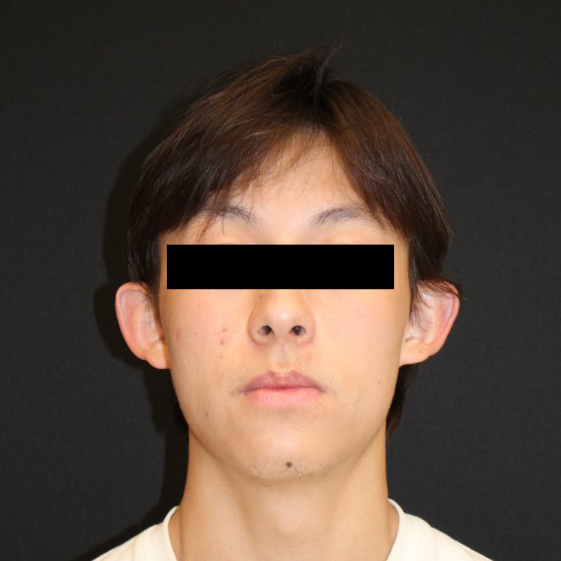 Otoplasty Before & After Gallery - Patient 749293 - Image 1