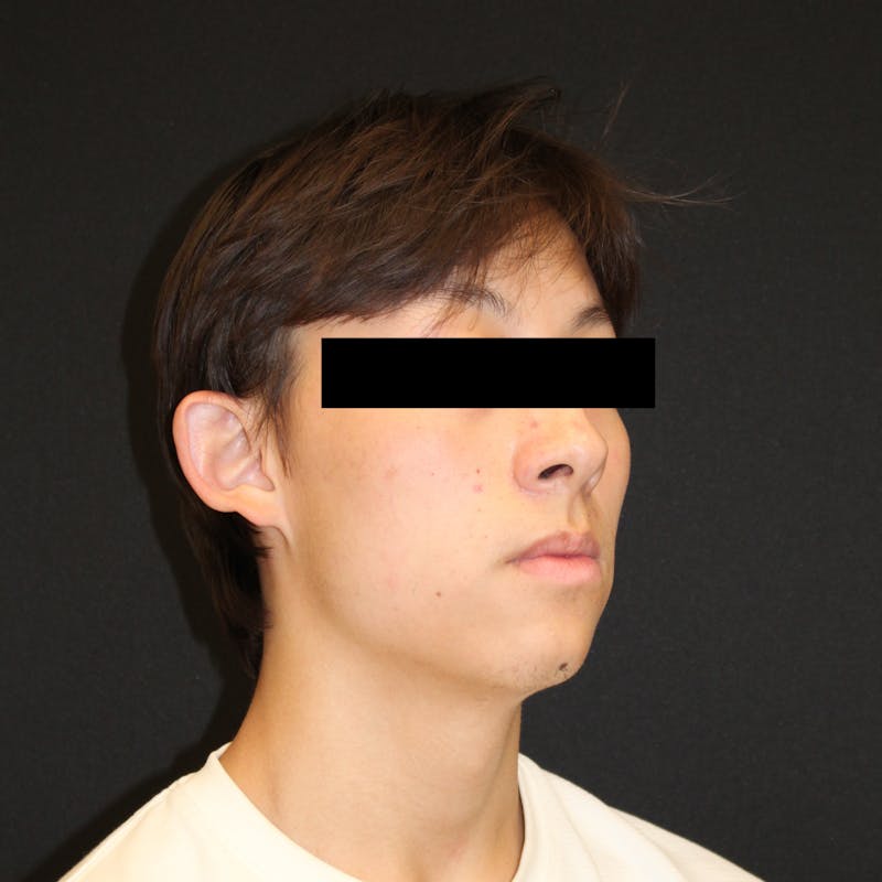 Otoplasty Before & After Gallery - Patient 749293 - Image 3