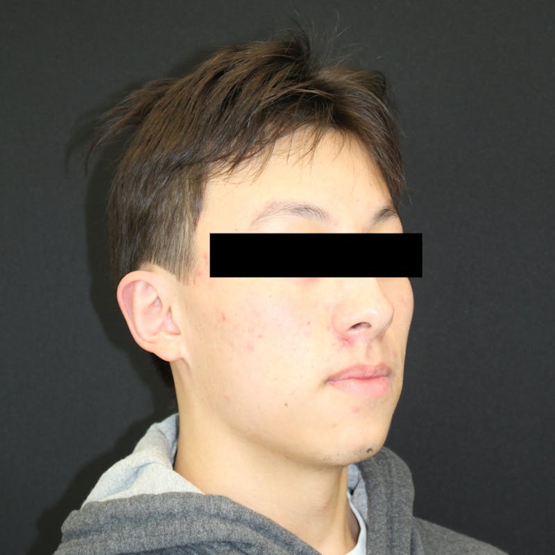 Otoplasty Before & After Gallery - Patient 749293 - Image 4