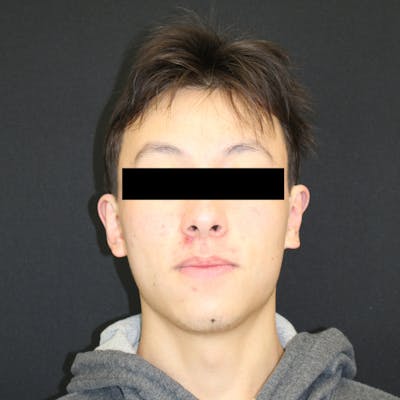 Otoplasty Before & After Gallery - Patient 749293 - Image 2