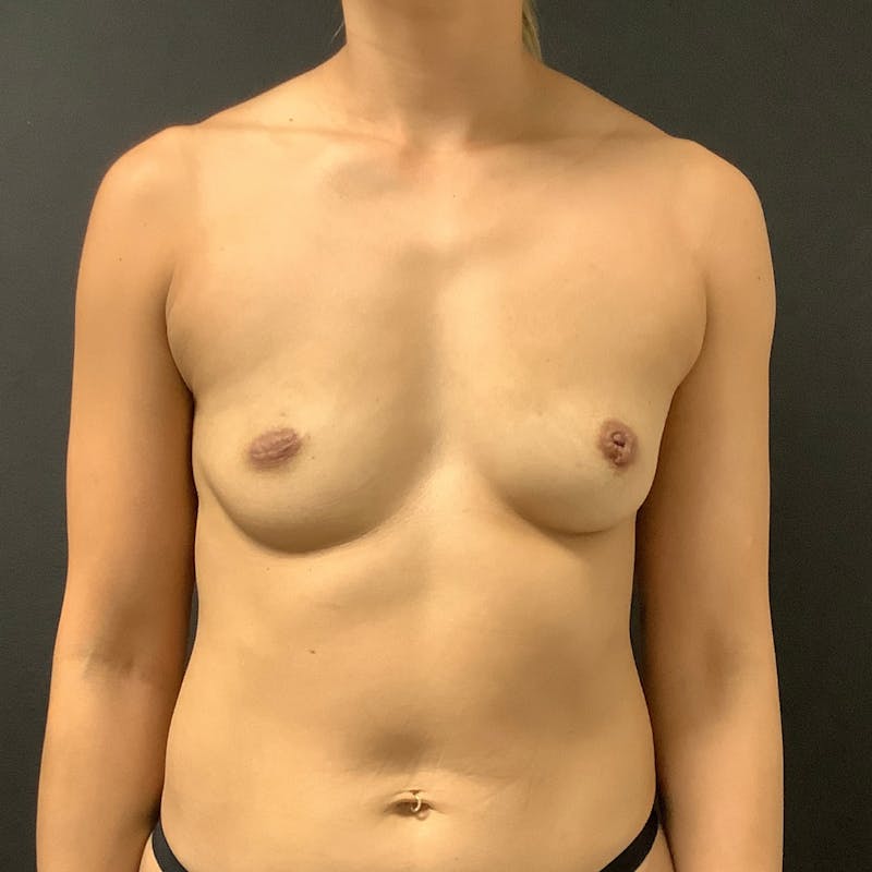 Breast Augmentation Before & After Gallery - Patient 259535 - Image 1