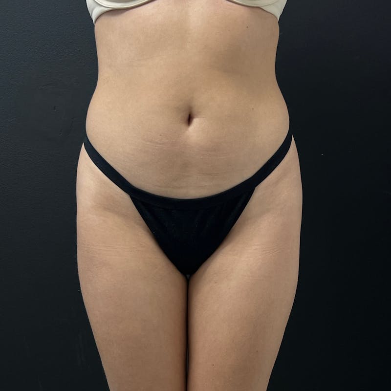 Liposuction Before & After Gallery - Patient 204231 - Image 1