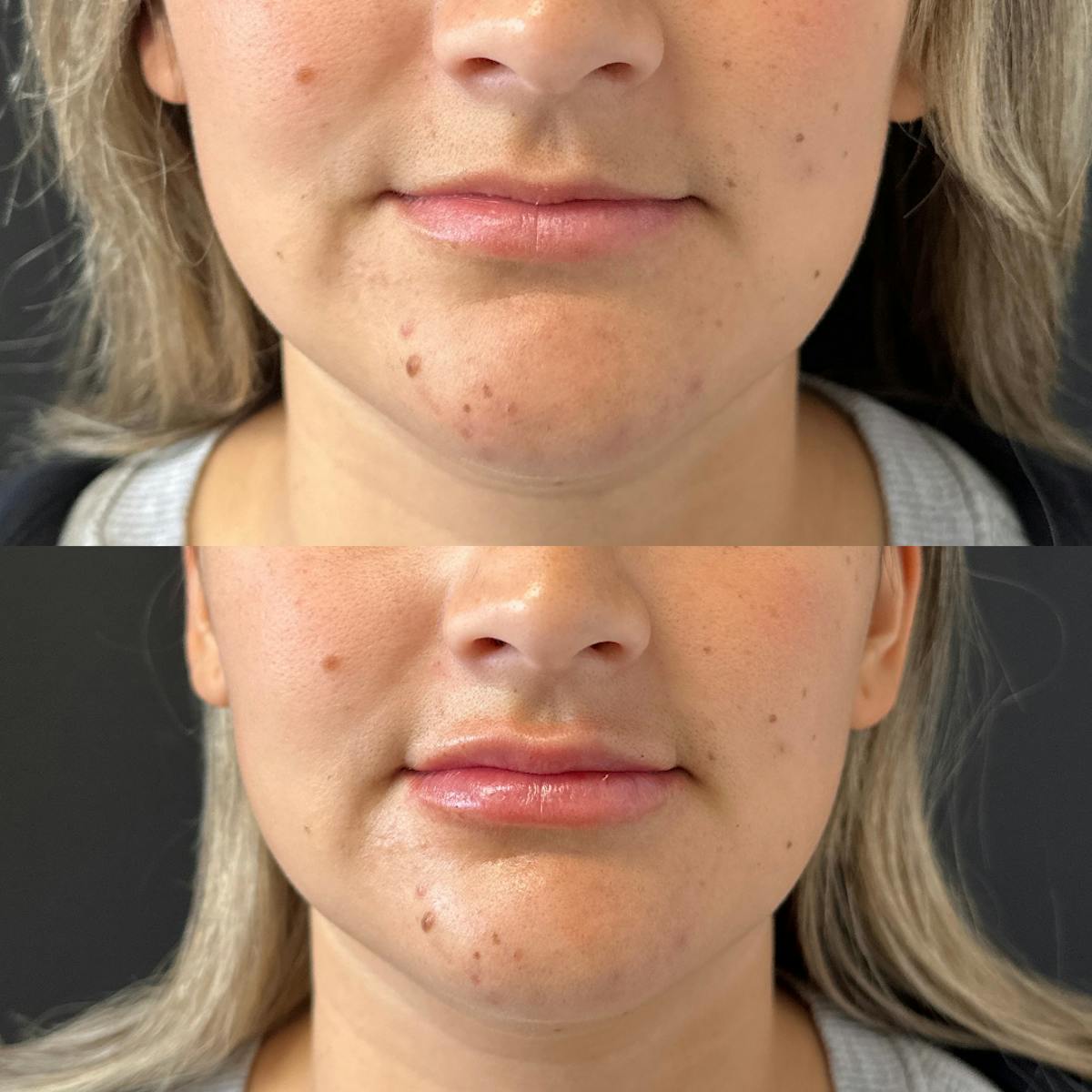 Dermal Fillers Before & After Gallery - Patient 126071 - Image 1