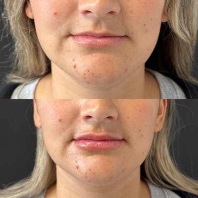 Dermal Fillers Before & After Gallery - Patient 126071 - Image 1