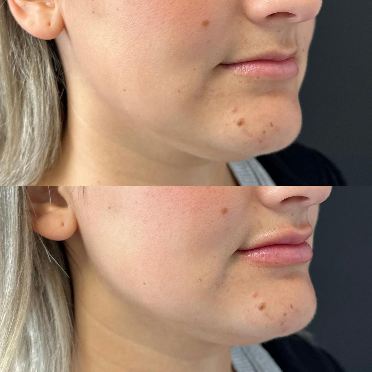 Dermal Fillers Before & After Gallery - Patient 126071 - Image 2