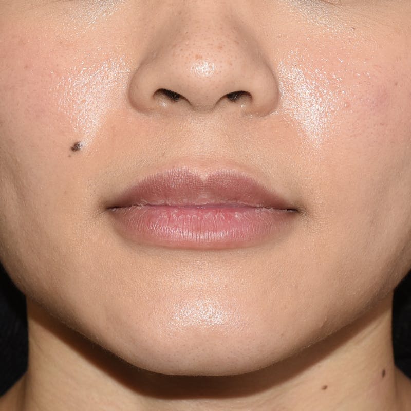 Rhinoplasty Before & After Gallery - Patient 315850 - Image 3