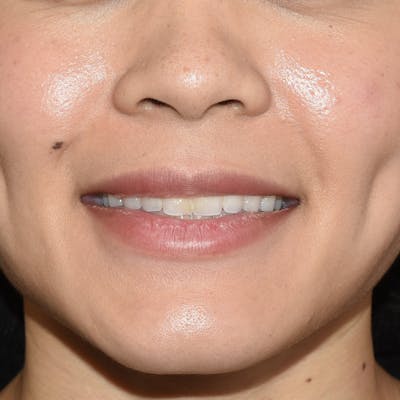 Rhinoplasty Before & After Gallery - Patient 315850 - Image 1