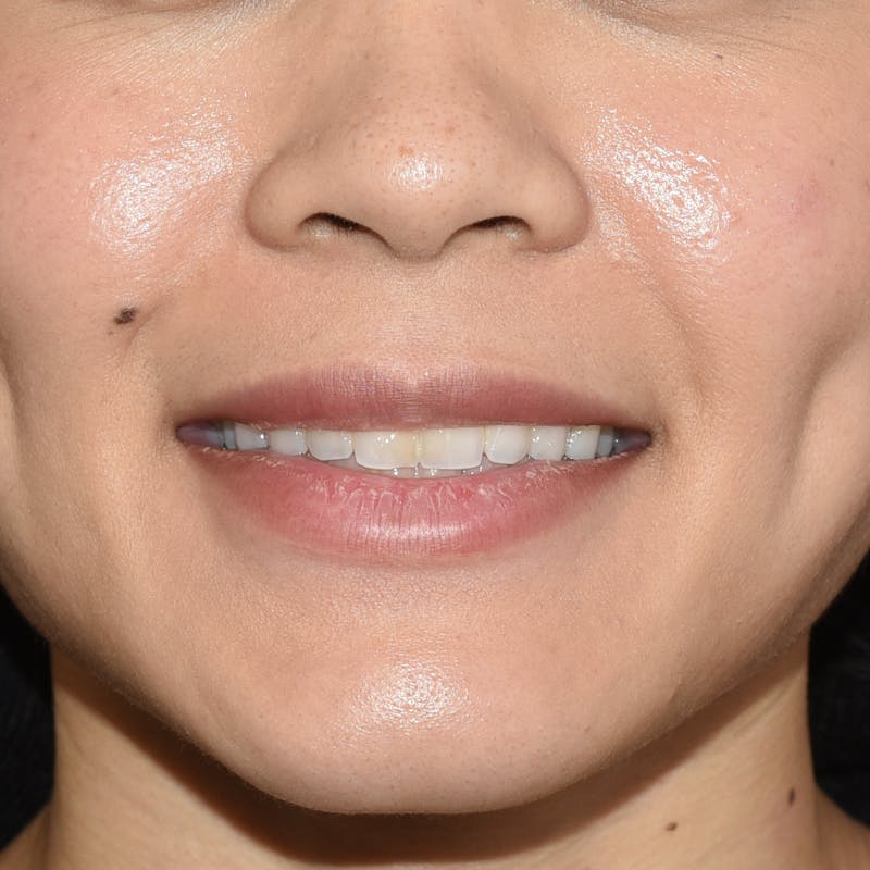 Rhinoplasty Before & After Gallery - Patient 315850 - Image 1