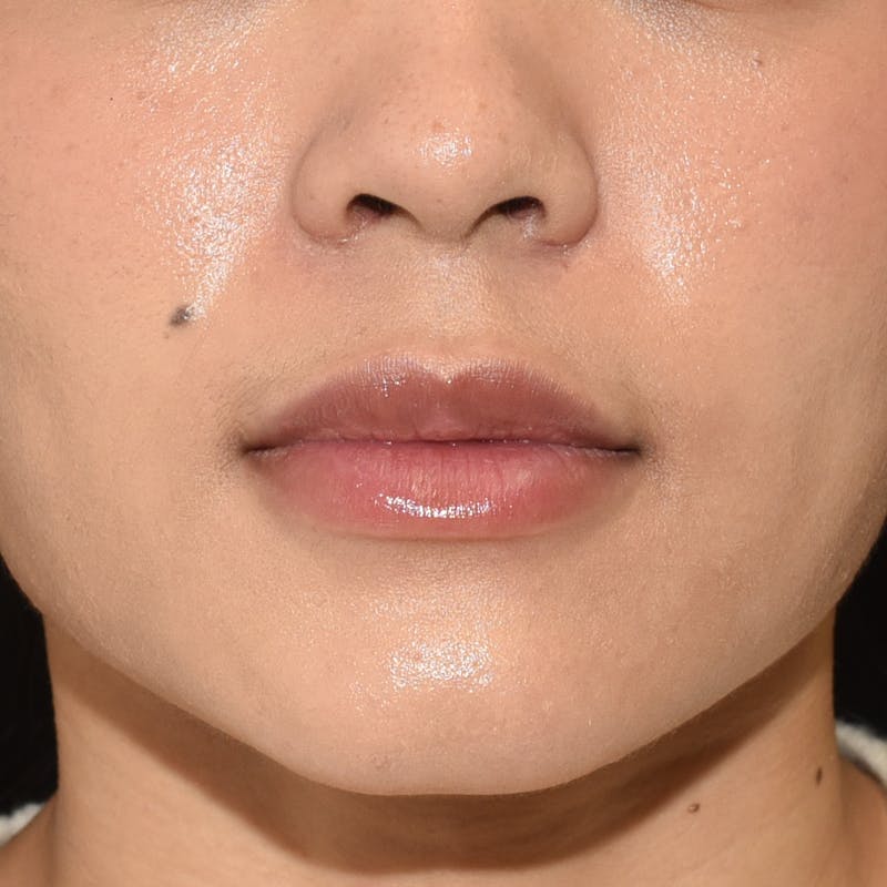 Rhinoplasty Before & After Gallery - Patient 315850 - Image 4