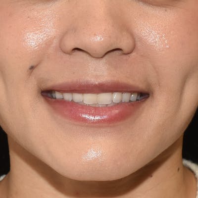 Rhinoplasty Before & After Gallery - Patient 315850 - Image 2