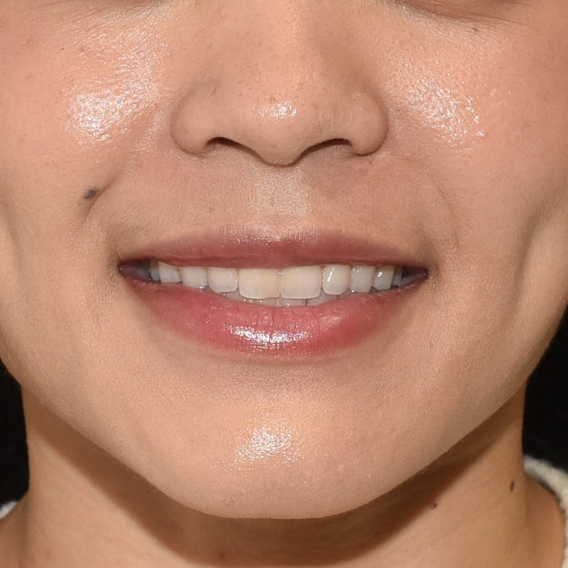 Rhinoplasty Before & After Gallery - Patient 315850 - Image 2