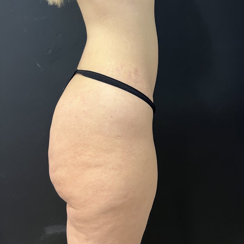 Aveli Before & After Gallery - Patient 611006 - Image 6