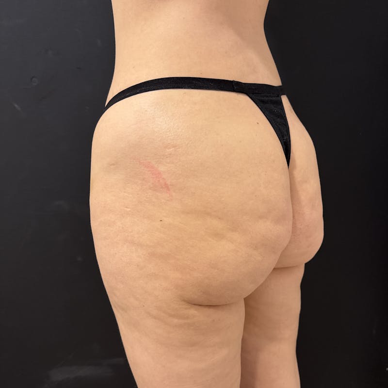 Aveli Before & After Gallery - Patient 611006 - Image 3