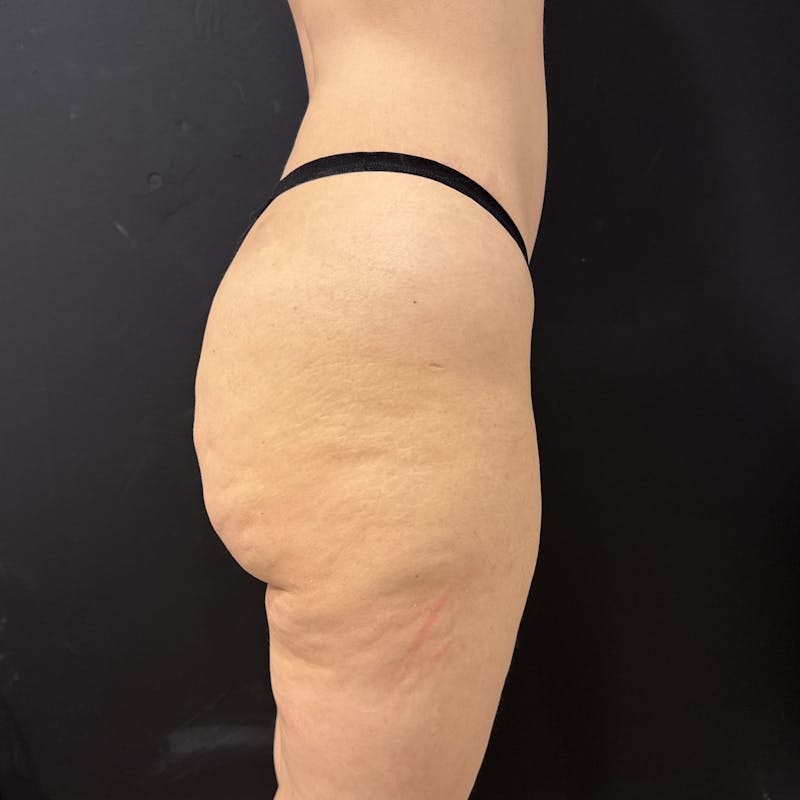Aveli Before & After Gallery - Patient 611006 - Image 5