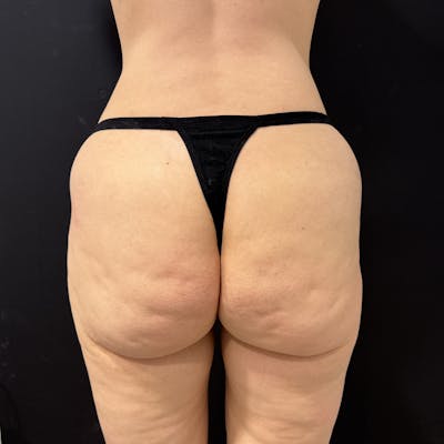Aveli Before & After Gallery - Patient 611006 - Image 1