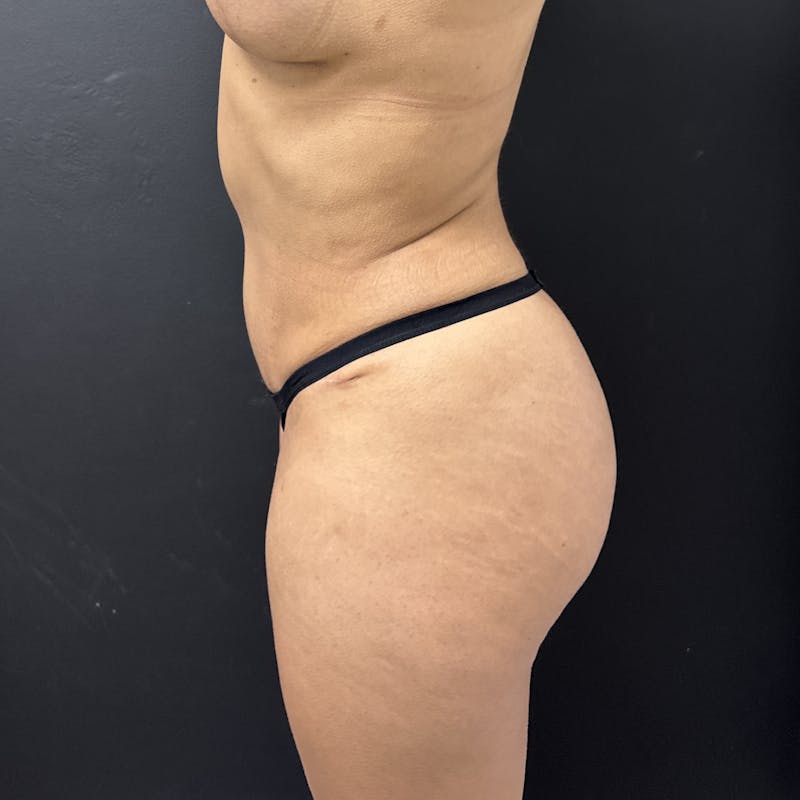 Liposuction Before & After Gallery - Patient 573625 - Image 6