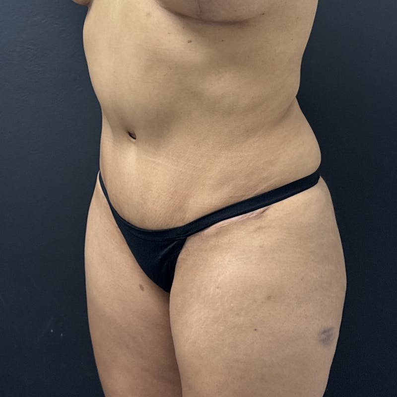 Liposuction Before & After Gallery - Patient 573625 - Image 7