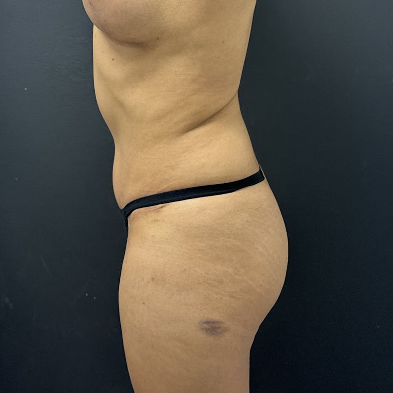 Liposuction Before & After Gallery - Patient 573625 - Image 5