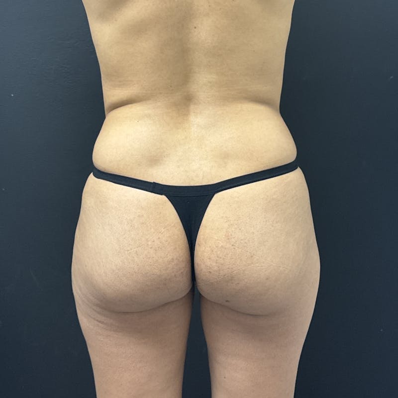 Liposuction Before & After Gallery - Patient 573625 - Image 1