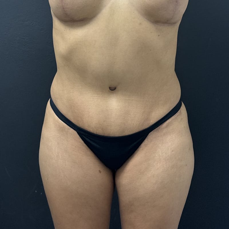 Liposuction Before & After Gallery - Patient 573625 - Image 9