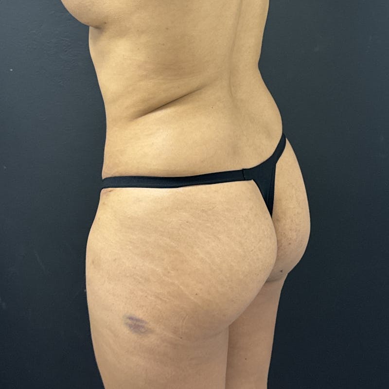 Liposuction Before & After Gallery - Patient 573625 - Image 3