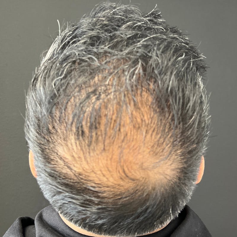 Hair PRP Before & After Gallery - Patient 267185 - Image 1