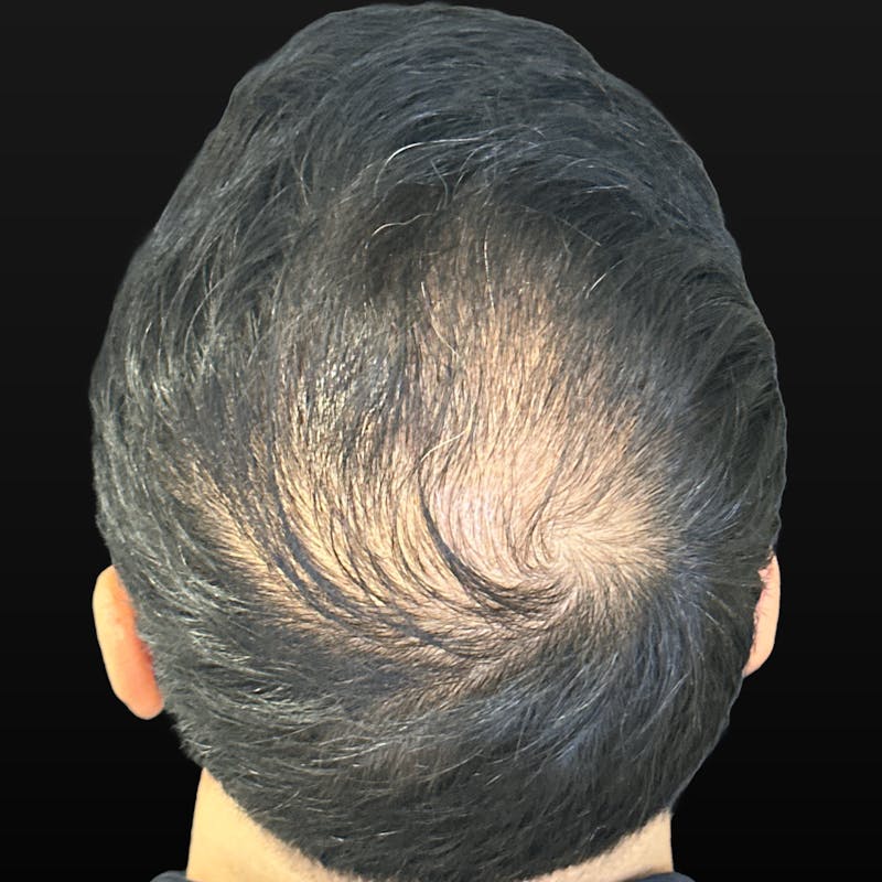 Hair PRP Before & After Gallery - Patient 267185 - Image 2