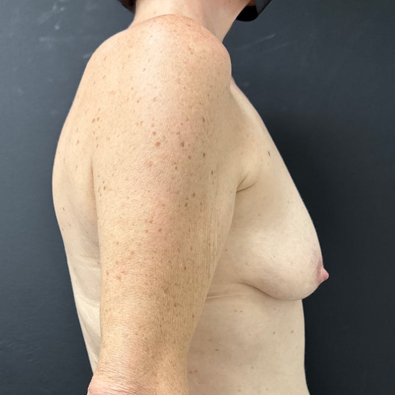 Preservé™ Breast Enhancement Before & After Gallery - Patient 231884 - Image 5