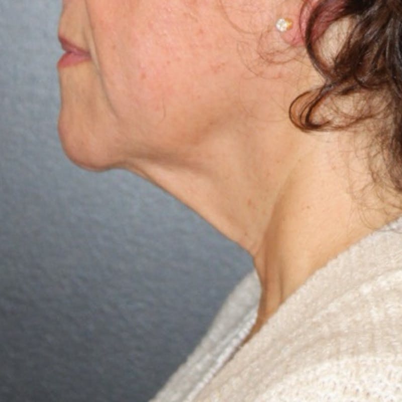 Facelift/Necklift Before & After Gallery - Patient 887159 - Image 1