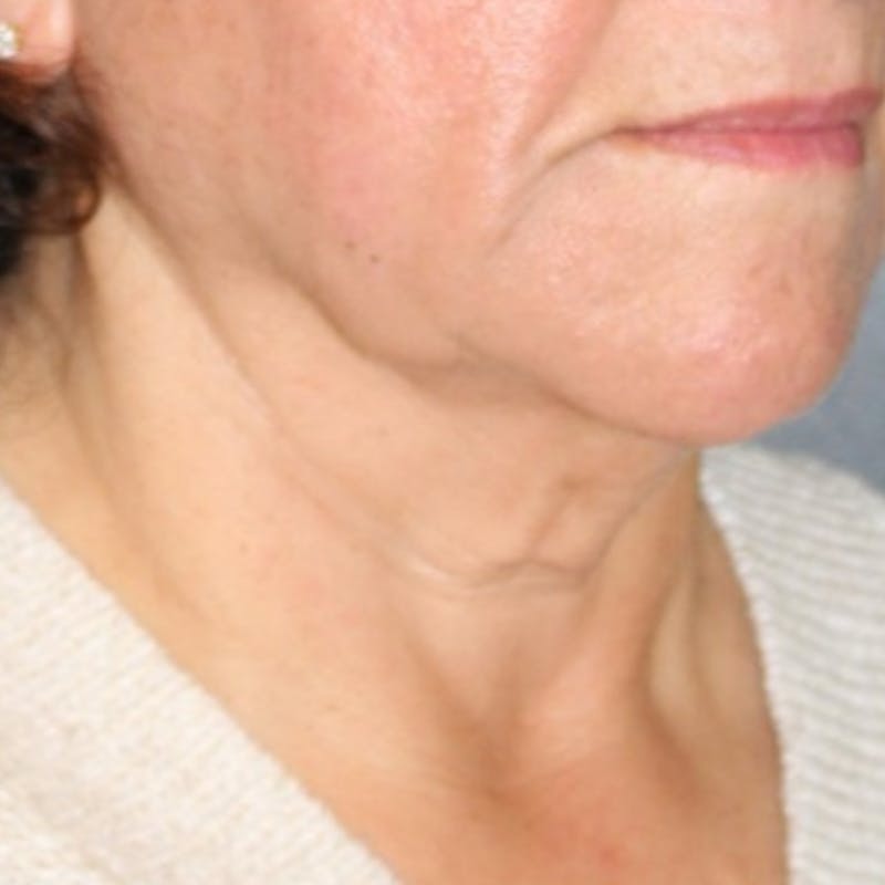 Facelift/Necklift Before & After Gallery - Patient 887159 - Image 3