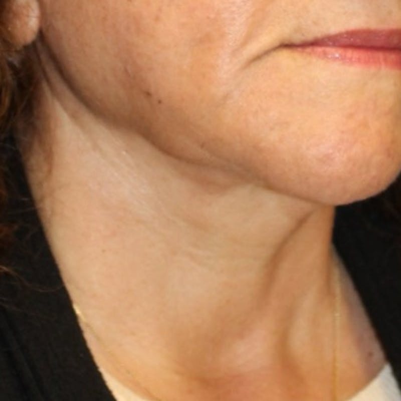Facelift/Necklift Before & After Gallery - Patient 887159 - Image 4
