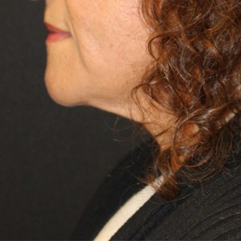 Facelift/Necklift Before & After Gallery - Patient 887159 - Image 2
