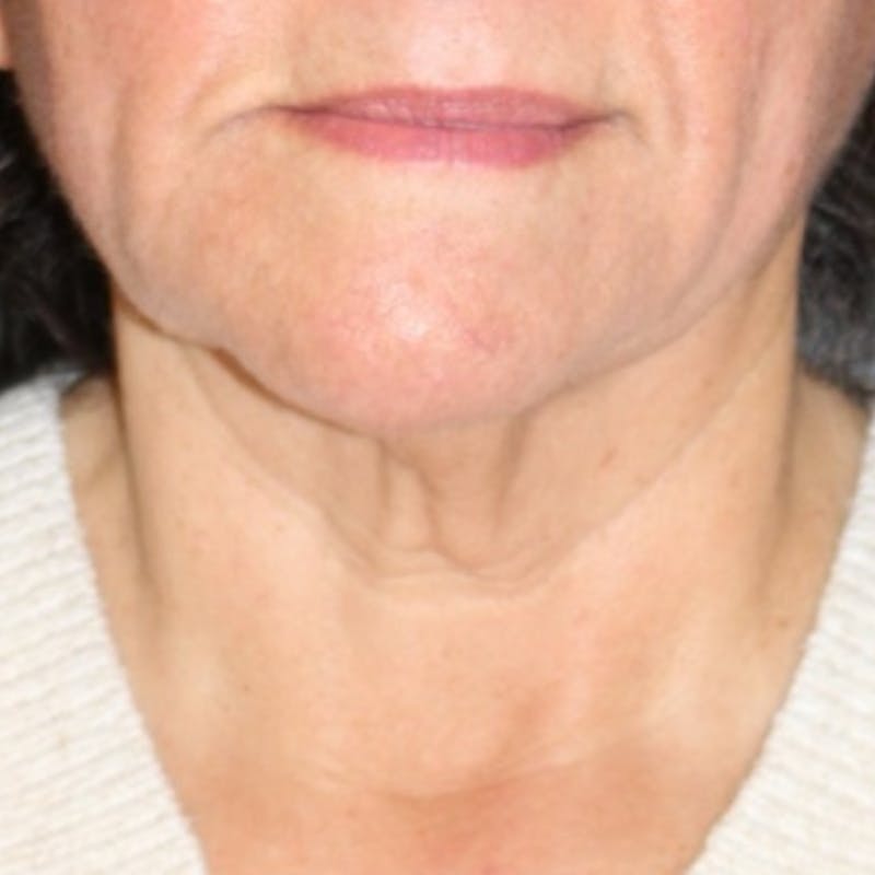 Facelift/Necklift Before & After Gallery - Patient 887159 - Image 5