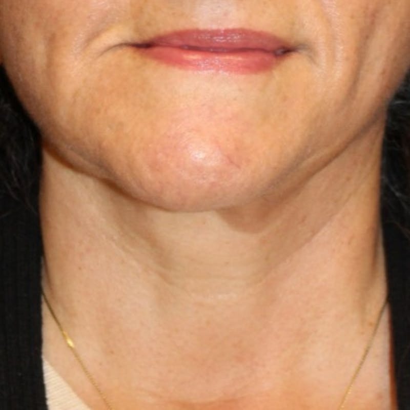 Facelift/Necklift Before & After Gallery - Patient 887159 - Image 6