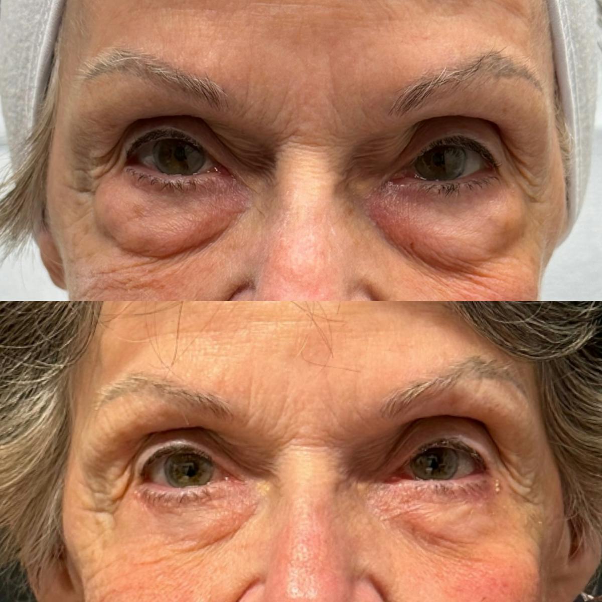 Eyelid Surgery (Blepharoplasty) Before & After Gallery - Patient 368054 - Image 1