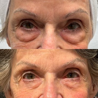 Eyelid Surgery (Blepharoplasty) Before & After Gallery - Patient 368054 - Image 1