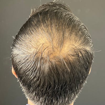 Hair PRP Before & After Gallery - Patient 172999 - Image 1