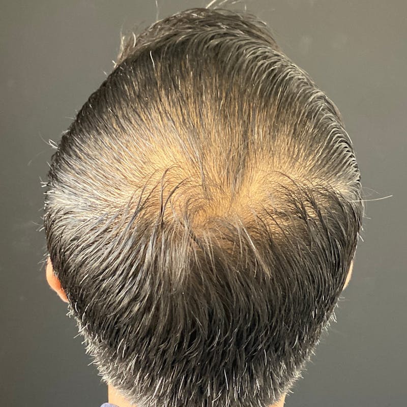 Hair PRP Before & After Gallery - Patient 172999 - Image 1